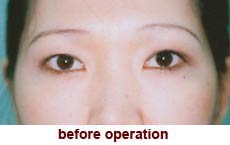 plastic-surgery-blepharoplasty